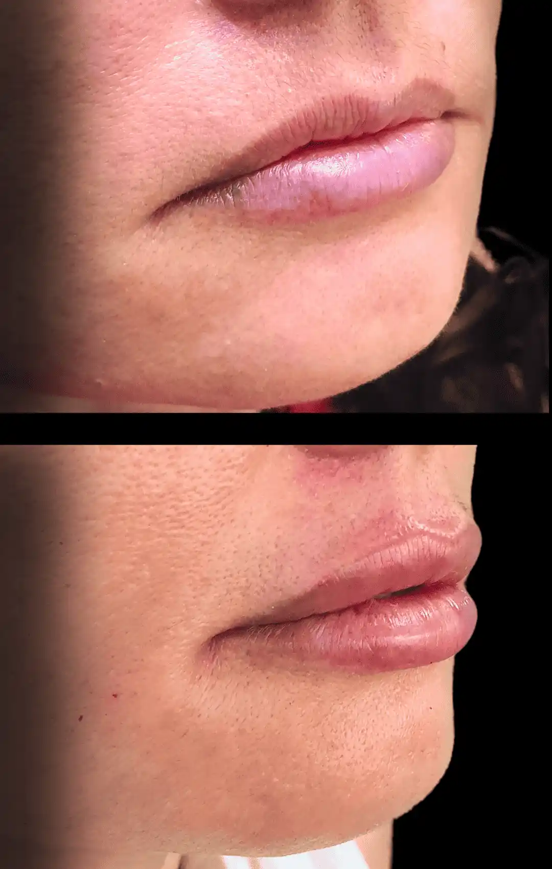 preenchimento de lábio e queixo