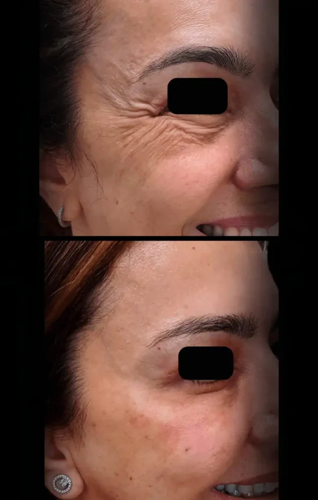 Rugas em pés de galinha