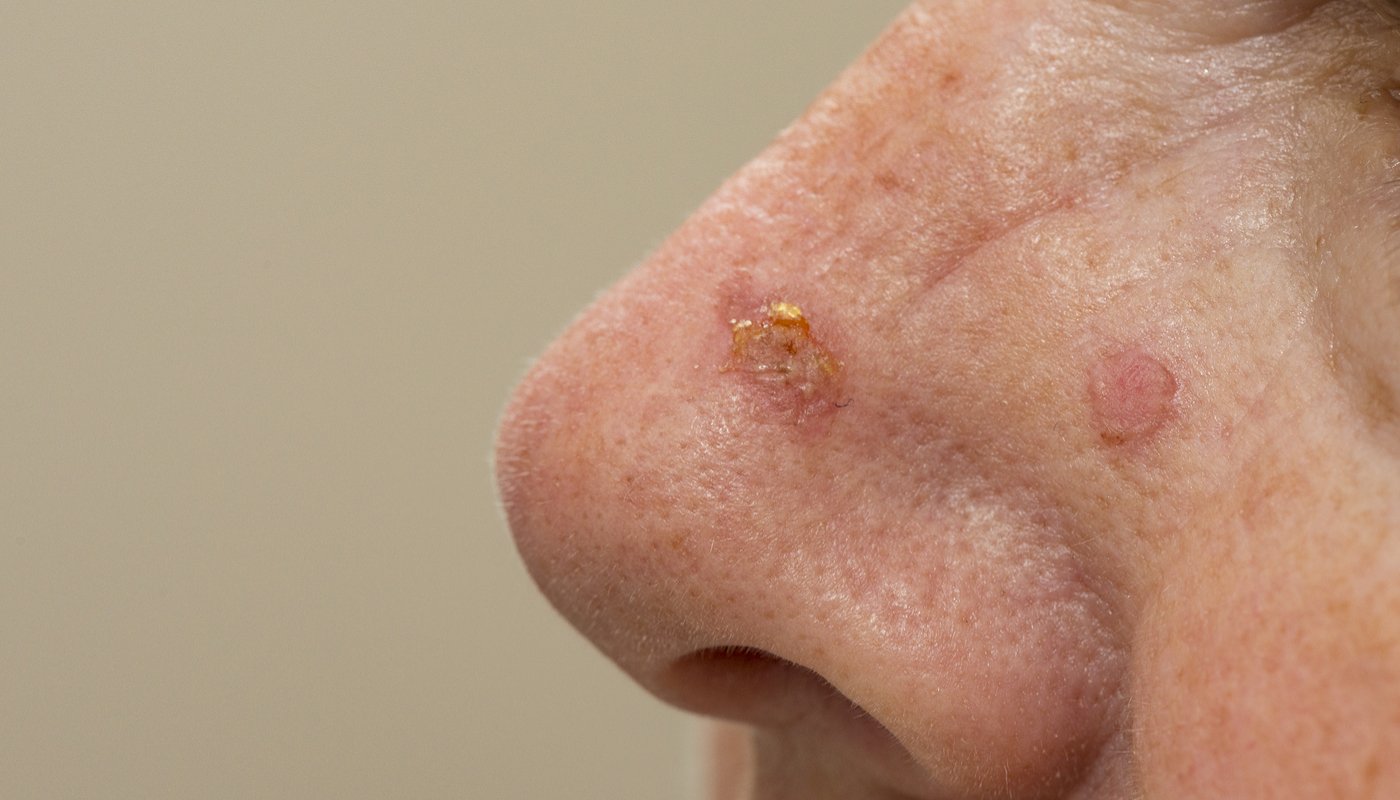 Imagem ilustrativa sobre carcinoma de pele